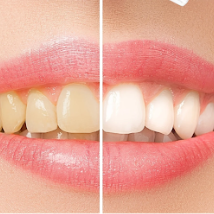 Lampe de blanchiment des dents